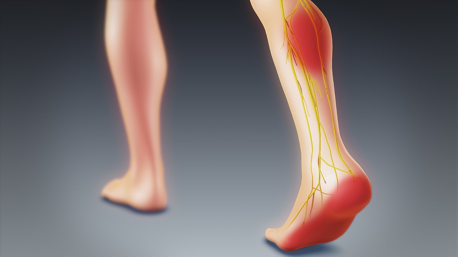 Ilustrație a membrului inferior cu traseul nervului sciatic iritat, de la fesă până la gambă