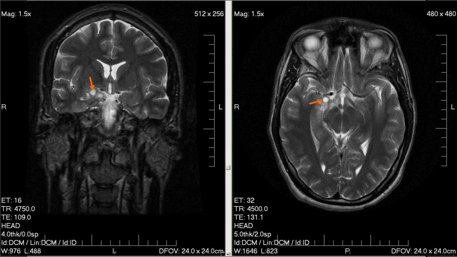 RMN cerebral în secțiune coronală și axială, cu un gliom vizibil în profunzimea emisferei stângi