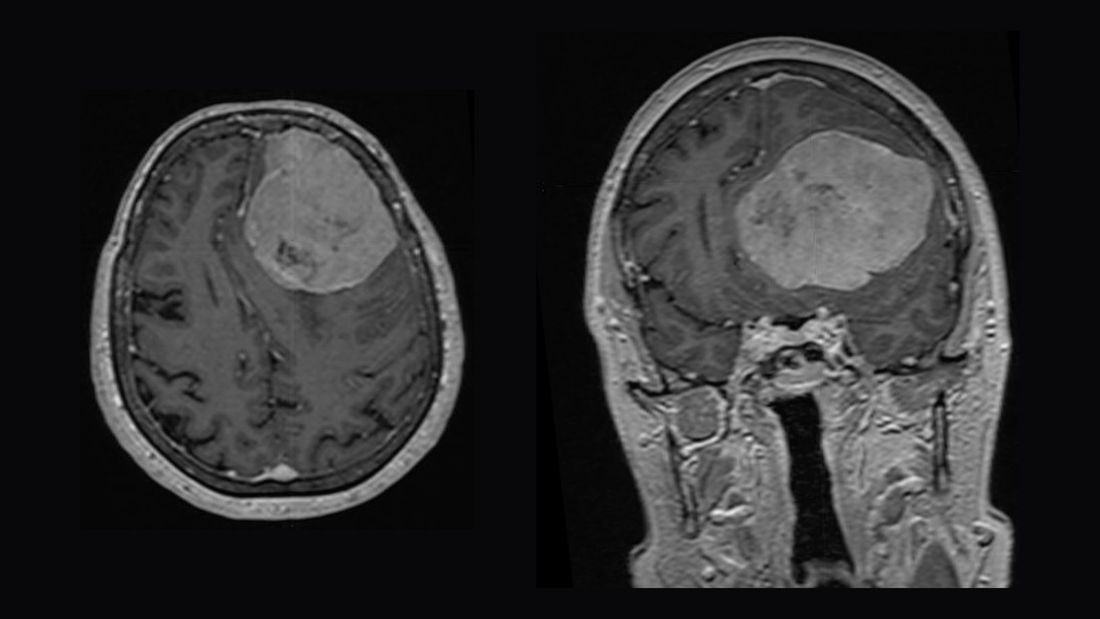 RMN cerebral cu substanță de contrast, în secțiune axială și coronală, care arată un meningiom cu bază largă de implantare durală la nivelul convexității