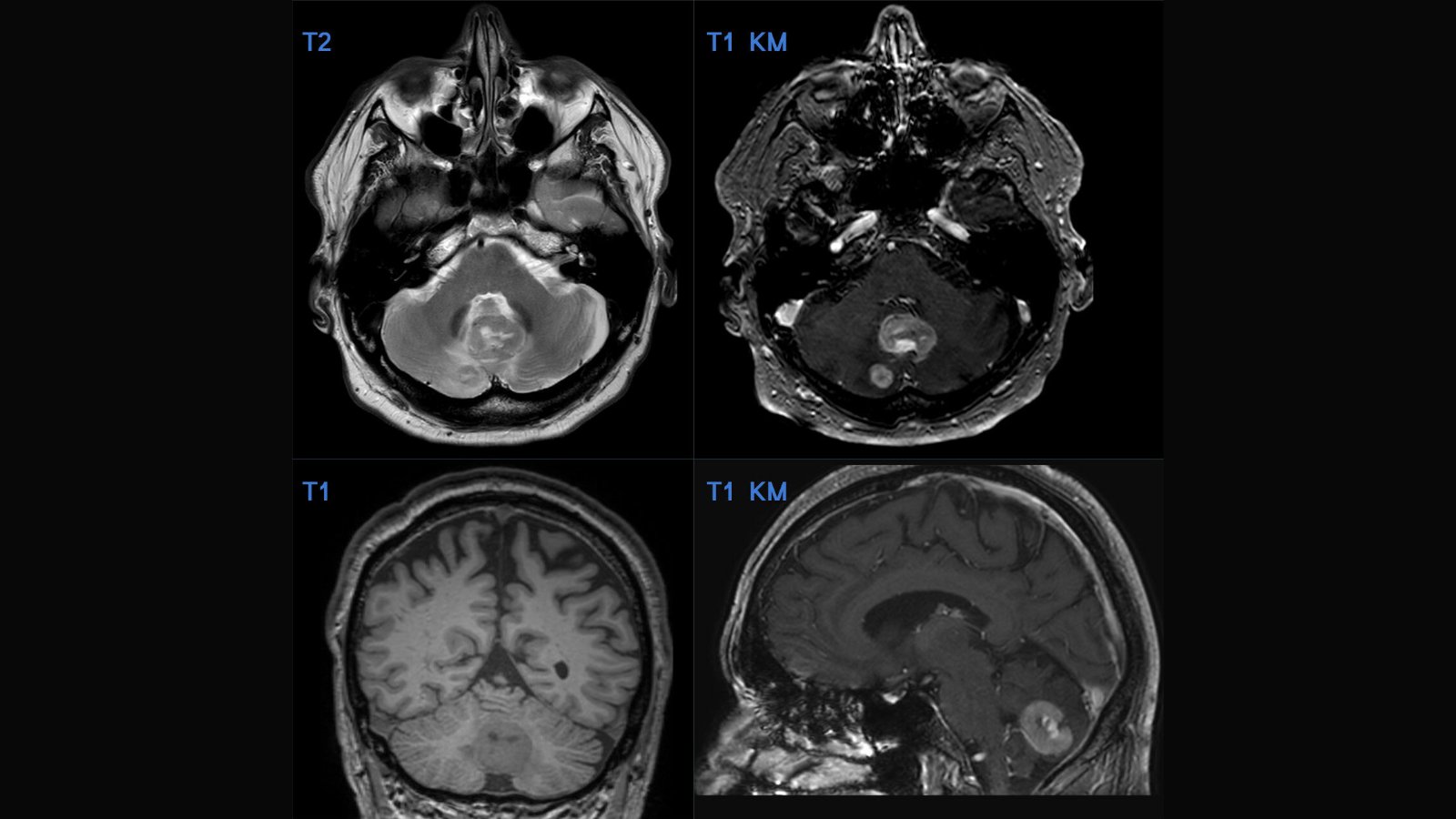 RMN cerebral în patru secvențe, cu metastaze la nivelul cerebelului care captează substanța de contrast