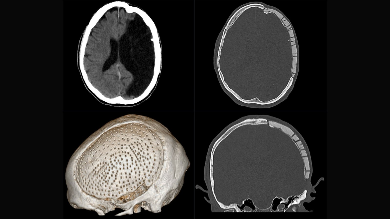 Imagini CT ale unui defect cranian, reconstrucție 3D a craniului și aspectul după acoperirea defectului cu proteză