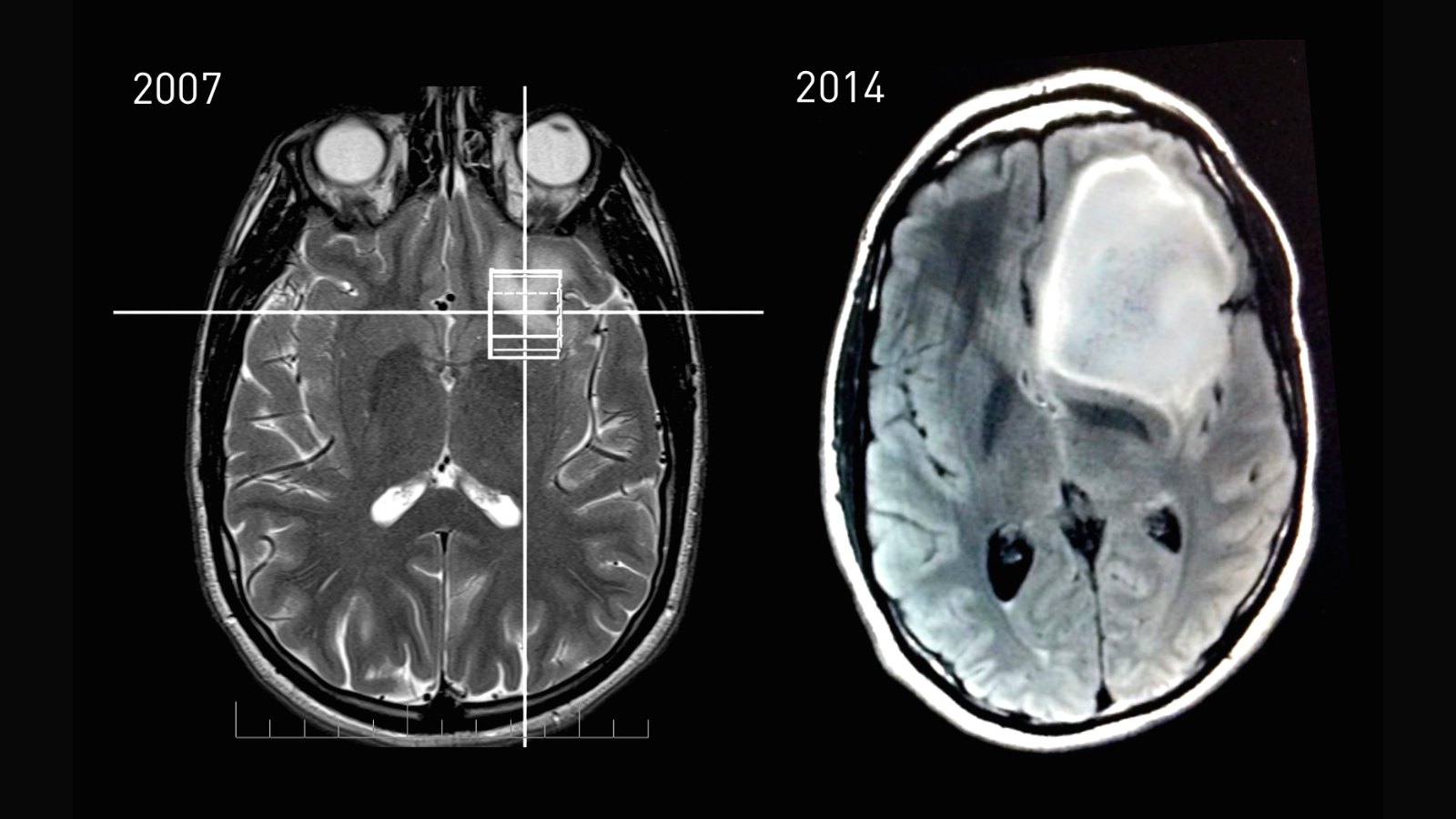 Două secțiuni axiale RMN ale aceluiași creier, la 2007 și 2014, care arată creșterea unei tumori în emisfera dreaptă